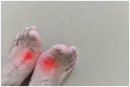 足の甲が腫れて痛い 原因不明の関節炎でお悩みの方へ 偽痛風 平野区 加美北 生野区 小川鍼灸整骨院小川鍼灸整骨院