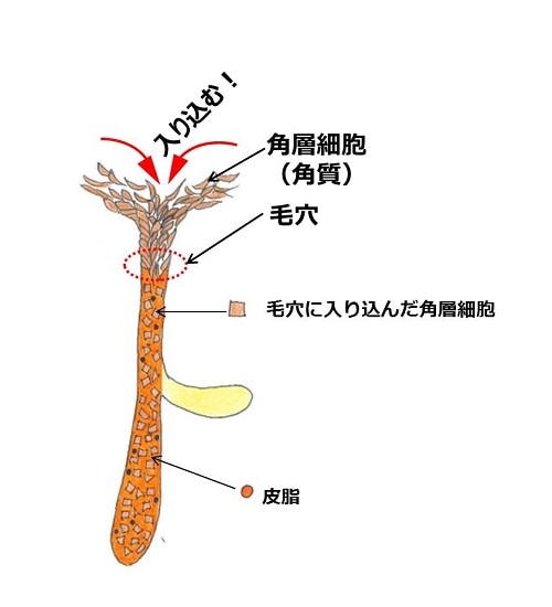 お風呂上がりに気になる眉間の白い角栓。 Tゾーンは皮脂の量が多いのでどうしても詰まりやすい場所のひとつ。 皮脂が多いと冷えやすく、血行も悪くなりがち。エクストラクションで毛穴をスッキリさせたあと、しっかり美容成分を浸透させてターンオーバーを促しましょう