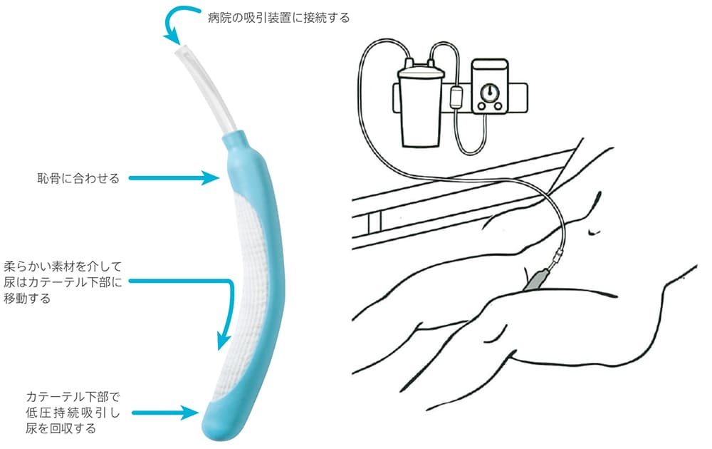 尿道カテーテル おしっこの管 は痛い？その方法と目的、注意点、体験談外科医の視点