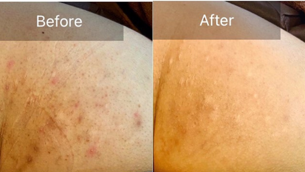 お尻のぶつぶつはニキビ？検査・治す方法を解説 画像あり 池袋マイケアヒルズタワークリニック