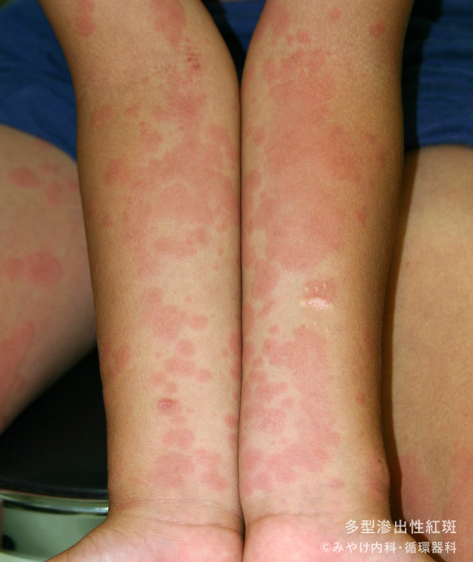 解熱した後にみられる湿疹野田市 小児科 千葉県 こどもの花粉症 こどもの漢方 喘息 アトピー性皮膚炎 アレルギー 結節性痒疹 たんぽぽこどもクリニック