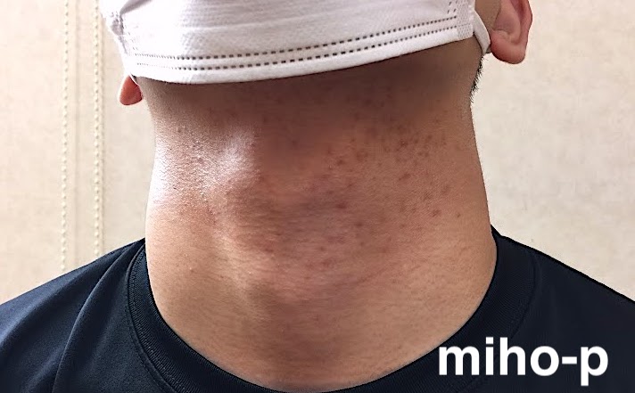 胸、背中、二の腕ぶつぶつは治りにくいニキビ？ではなくマラセチア毛包炎 かも・背中ニキビ難治性ニキビあゆ皮フ科クリニック高槻市の一般皮膚科・小児皮膚科・皮膚外科・美容皮膚科