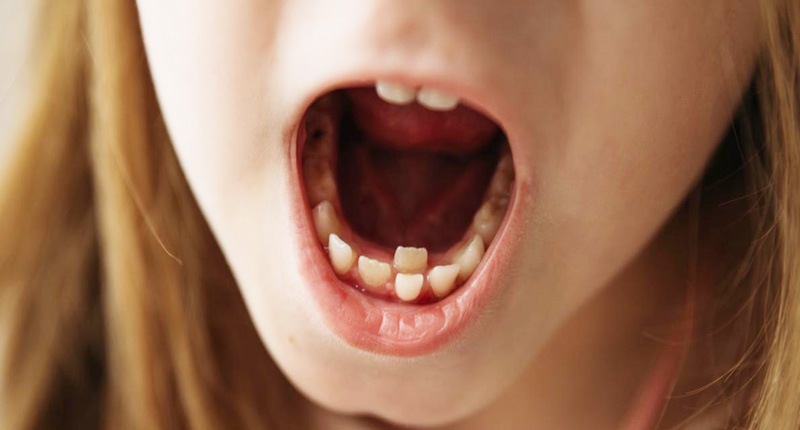 虫歯の子供、虫歯と虫歯菌、歯磨きをする子供のイラスト素材FYI01653622ストックフォトの QleanMarket キュリンマーケット