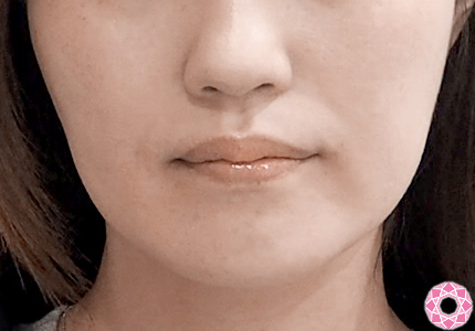 症例写真 エラのボトックス小顔注射美容整形はTCB東京中央美容外科