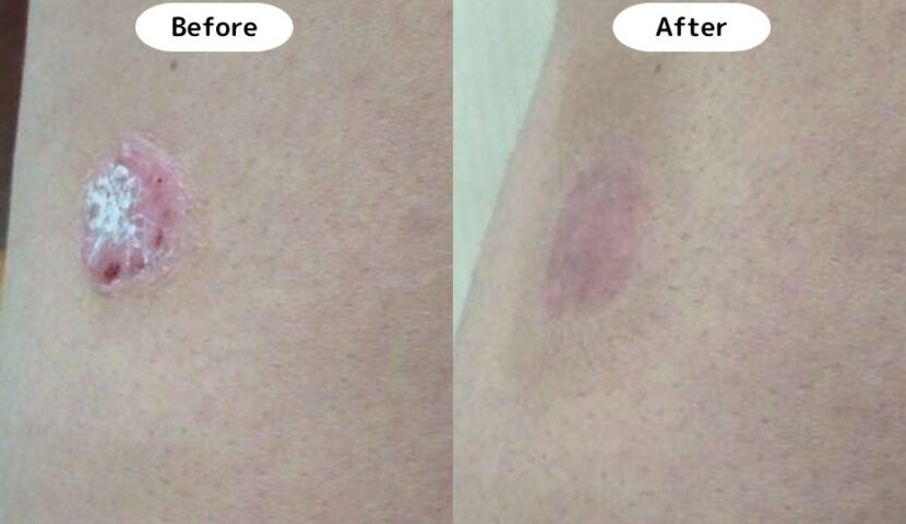 頭皮にできる乾癬 かんせん とは？主な症状や原因、治療方法を解説イースト駅前クリニック女性外来