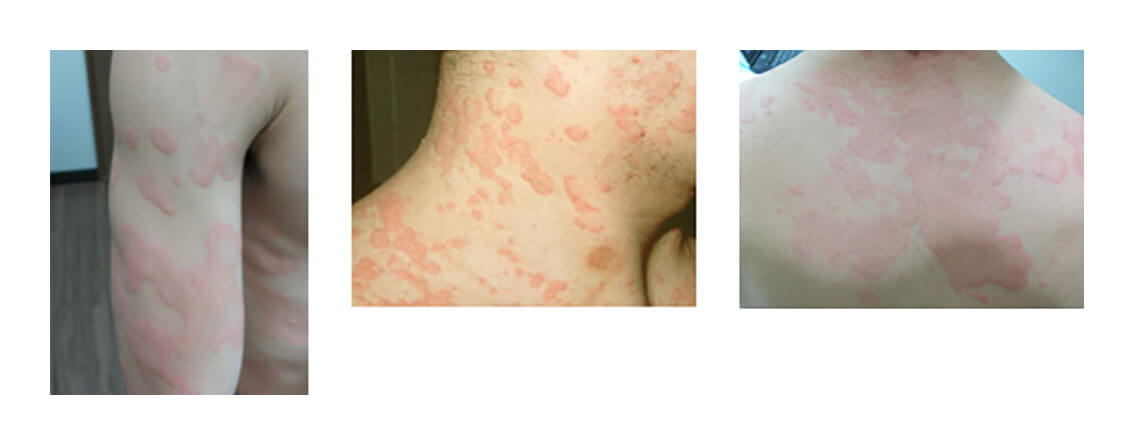 じんましん・湿疹きむら内科小児科クリニック名古屋市緑区