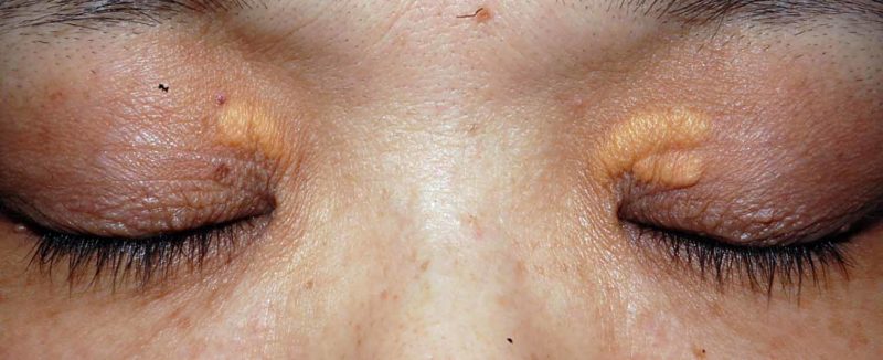 眼瞼黄色腫の治療医療法人社団麗美会