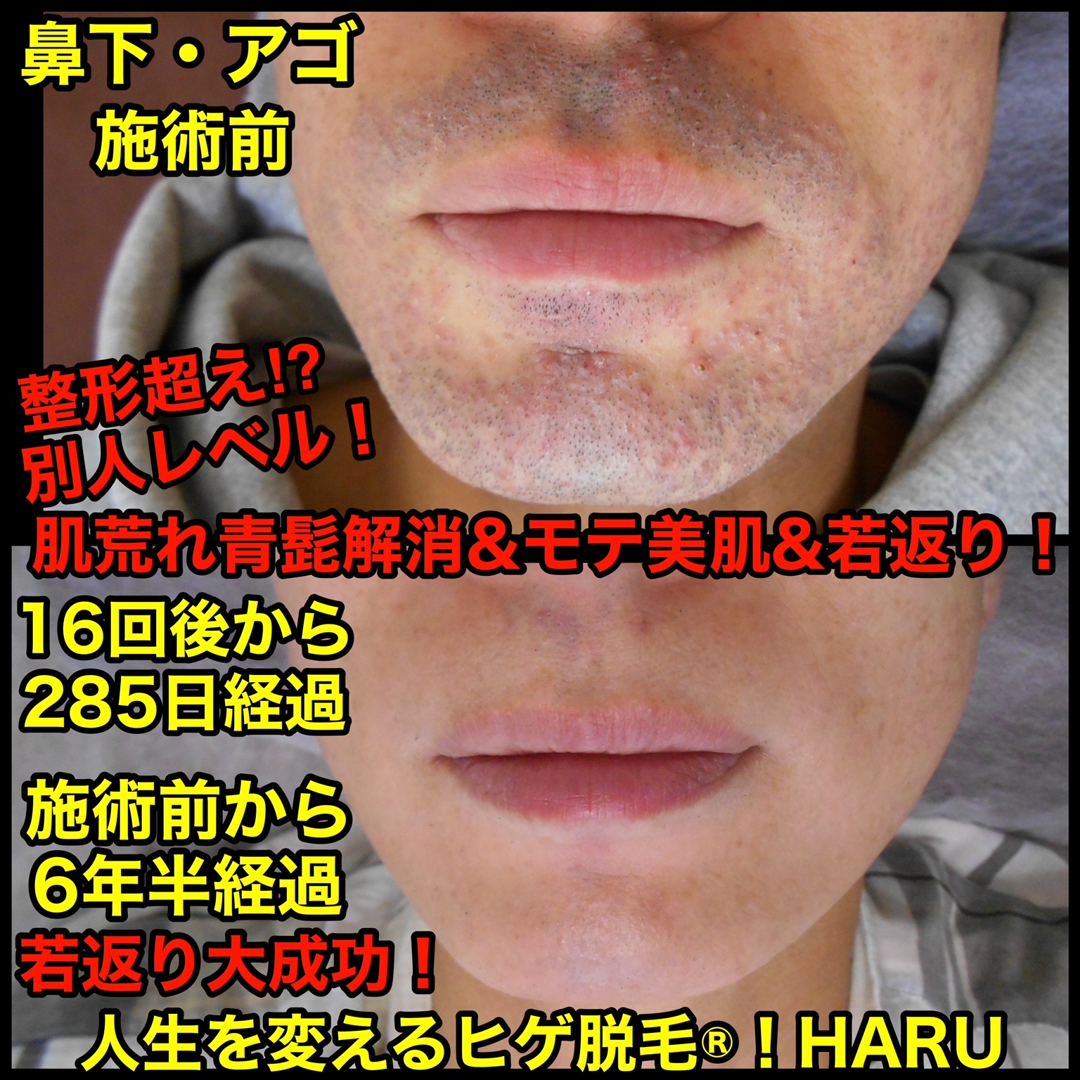 鈴木 直哉さんのヒゲ脱毛症例解説 2回目- ヒゲのゴリラ脱毛