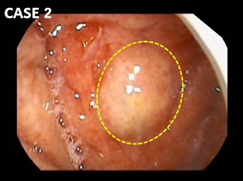 咽頭の病気最上クリニック－予約優先診療・日帰り手術で安心治療 – 姫路の耳鼻科