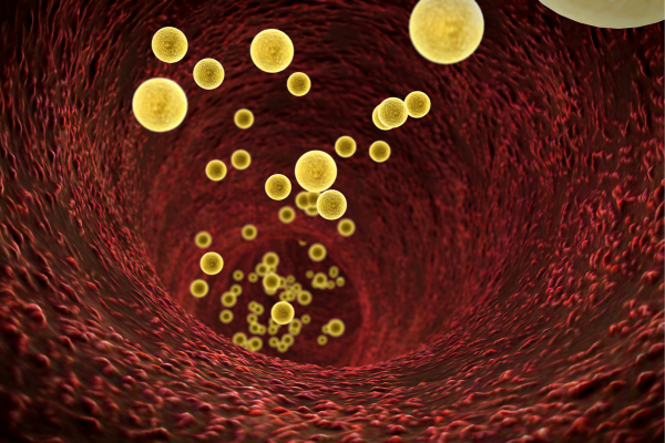 脂質異常症 高脂血症木村眼科・木村内科・木村コンタクトレンズ