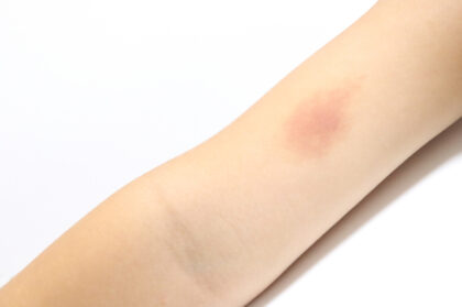 青あざ・黄色いあざは危険？体にできたときに知っておきたい原因・経過・注意点湘南カイロ茅ヶ崎整体院