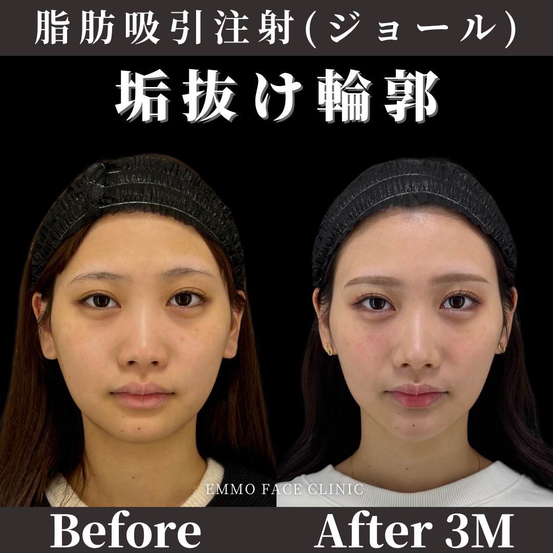 頬の脂肪を落とす方法：超荒療治で小顔へ