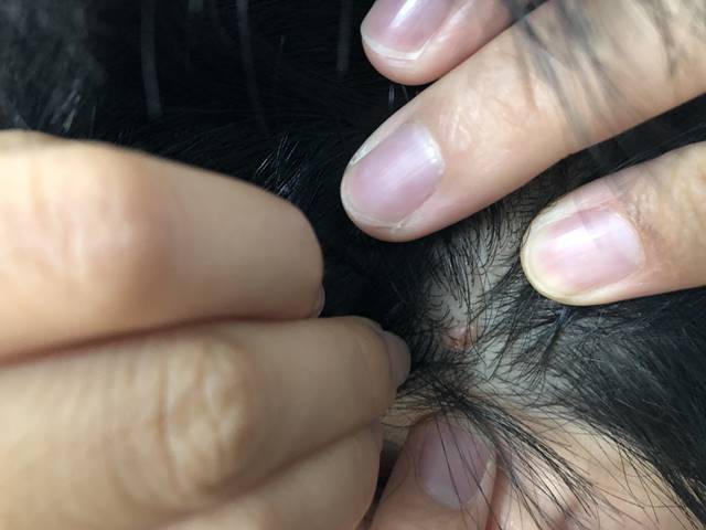 男性の方へ大阪のニキビ・ニキビ跡治療ならプライベートスキンクリニック