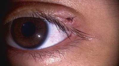 ものもらいになっちゃったから記念撮影。👀﻿ 麦粒腫って技名みたいでかっこよくない？﻿ 爆竜朱！！🔥🔥🔥⚔⚔⚔﻿ ﻿ともかほちゃんねる﻿-------------------------------------﻿ 📹YouTube:ともかほちゃんねる﻿📹YouTube:ともかほのげーむ﻿ 🎵TikTok:ともかほカップル