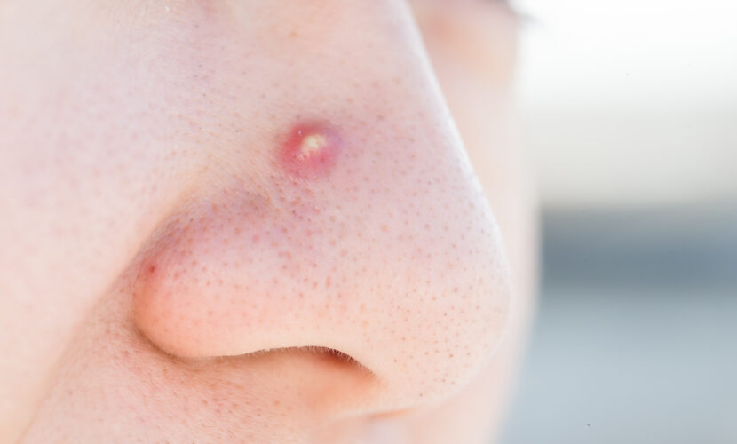 鼻の中に何かできている、痛い 。それって鼻前庭炎？もしかすると腫瘍？尾道市向島町の小坂耳鼻咽喉科クリニック