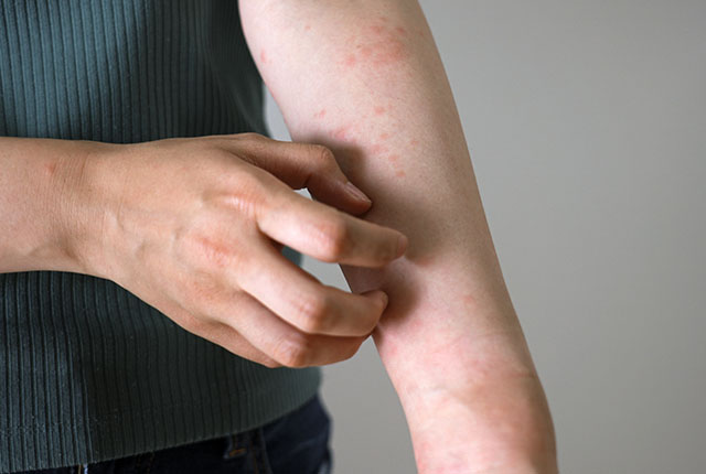 蕁麻疹 じんましんひびきの皮ふ科 北九州市八幡西区学研都市ひびきのにある皮膚科