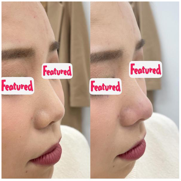 閲覧注意🙏角栓がヤバい方へお風呂上がりに、なんか毛穴から飛び出してるニョロニョロ角栓👀 これ、気持ち悪いですよね😭このニョロニョロは一時的なもの。 角栓が水を含むと飛び出してきます。 なので、時間が経てばいつもの詰まり毛穴に戻ります。 角栓の