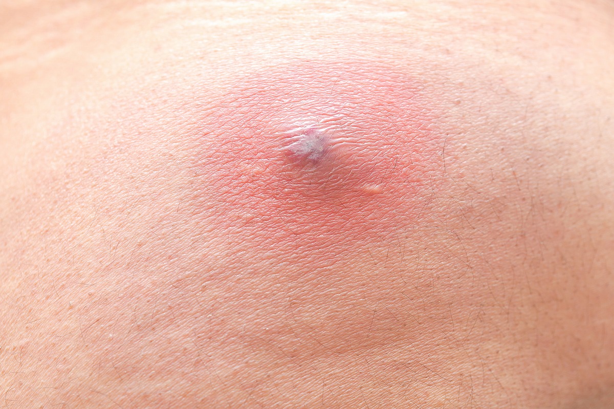 解消！首周りにできるニキビの原因と対処法 - ニキビケアは根本対策のこことみグループ cocotomi