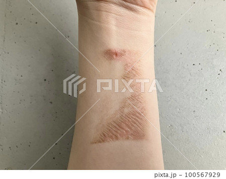 やけど 熱傷ひびきの皮ふ科 北九州市八幡西区学研都市ひびきのにある皮膚科