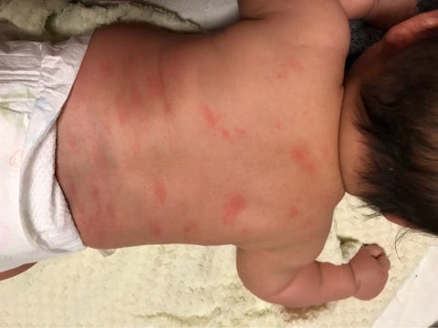 乳児湿疹 おむつかぶれ新鎌ケ谷くぼた皮膚科泌尿器科鎌ケ谷市の皮膚科・泌尿器科