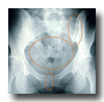 骨盤裂離骨折について 金沢市アルコット接骨院