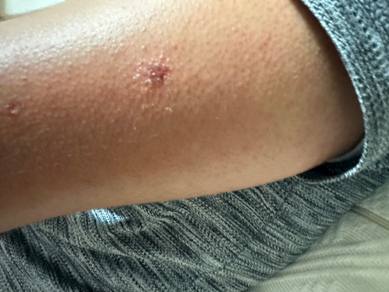 虫刺され岡山の美容皮膚科・皮膚科 まつい皮ふ科