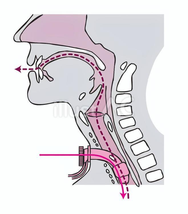 気管切開のイラスト 子供・バッグバルブマスク付きかわいいフリー素材集 いらすとや