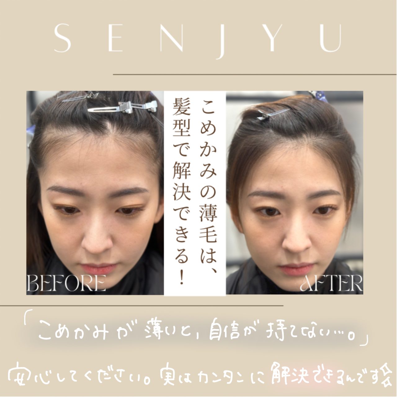 女性の薄毛患者様 23歳 Ludwig Scale1型駅前AGAクリニック 新宿、北千住、大阪、京都、岡山、鹿児島など