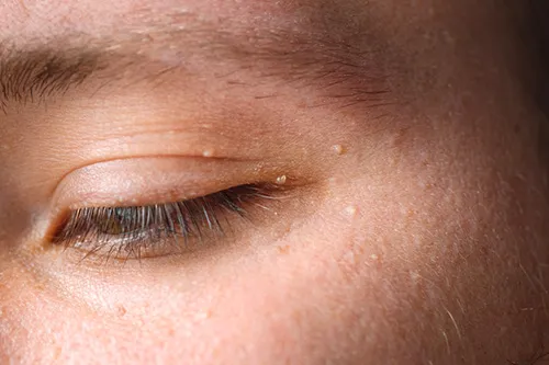 稗粒腫 はいりゅうしゅ 目の周りや顔にできる白いポツポツ - 東京・大阪の美容皮膚科ならFLALU フラルクリニック