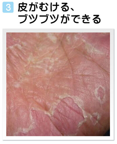 あせも」に注意、汗管詰まり皮膚に炎症 かゆみ強いと「とびひ」もヨミドクター 読売新聞