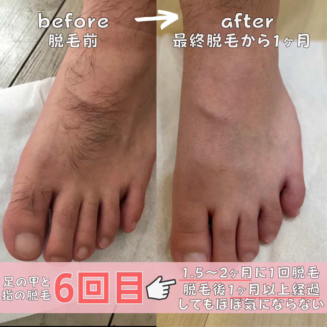 足の甲の毛を処理したい！おすすめのカミソリや注意点を解説