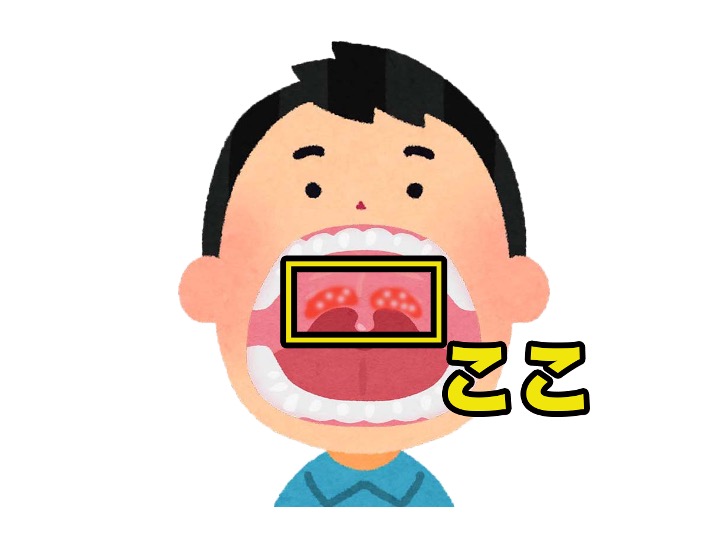 夏に流行！ヘルパンギーナとは？のどの痛みや高熱でつらい「ヘルパンギーナ」 小さなお子さまがかかりやすく、毎年夏に流行します🌞 ✓潜伏期間や症状は？ ✓ 感染経路と予防方法 ✓ 受診の目安や治療法 ✓ おうちでできるケアのポイント ✓ 登園・登校OKのタイミング