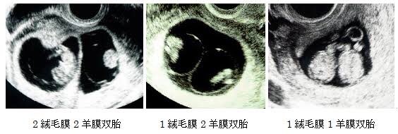 DD双胎・MD双胎・MM双胎について - 妊娠中のお悩み相談 - NIPT平石クリニック