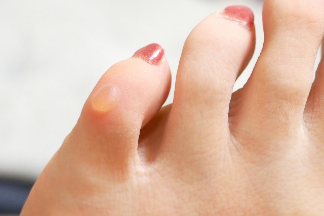 靴擦れの水ぶくれがパンパンの場合の対処法は？原因や治るまでの期間を医師が解説皮膚のトラブル解決のための情報メディア-皮膚科Medi