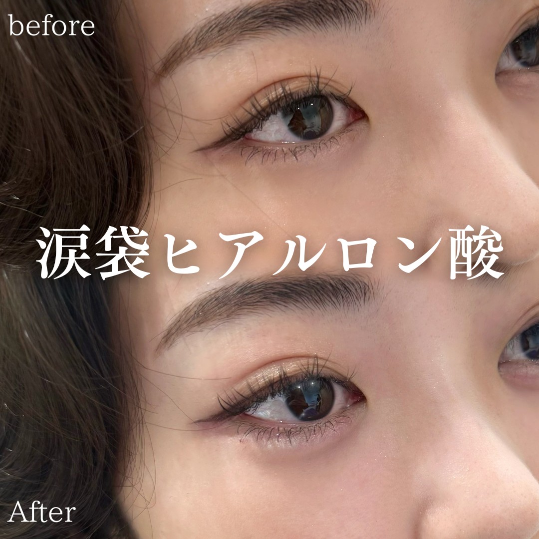 涙袋とクマの違いは？涙袋のメリットや涙袋形成・クマ取りの美容施術について解説DaysBeautyClinic