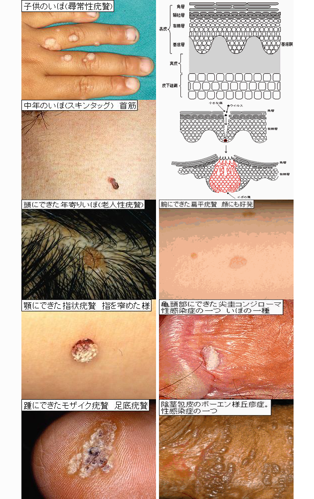 いぼ大田区大森・大木皮膚科 尋常性疣贅・イボ治療専門外来