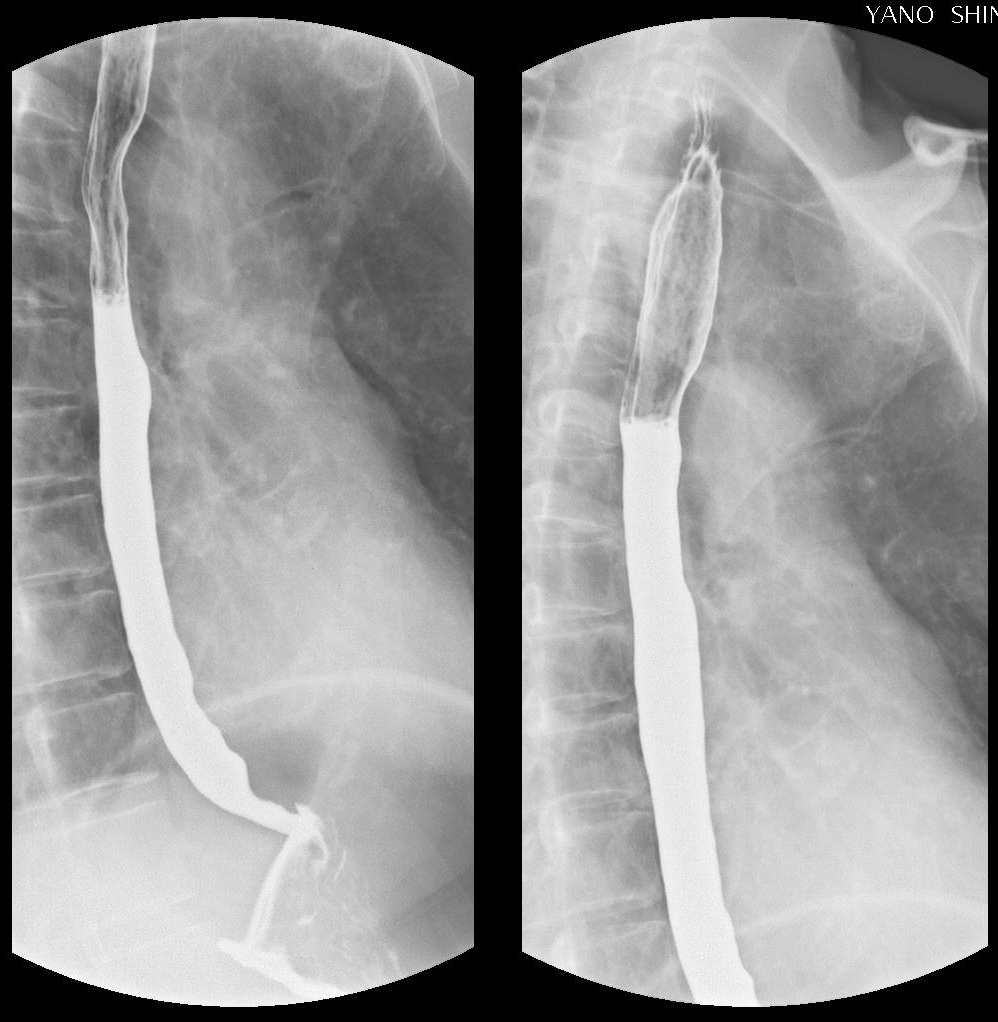 バリウム検査で異常と言われたらさいたま市浦和消化器内視鏡クリニック内視鏡検査・消化器内科