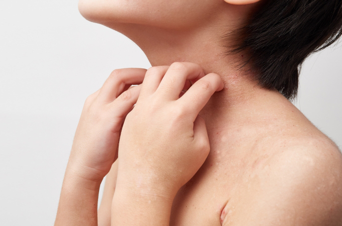 金沢 野々市 皮膚科あせもなら松井皮膚科クリニックへ