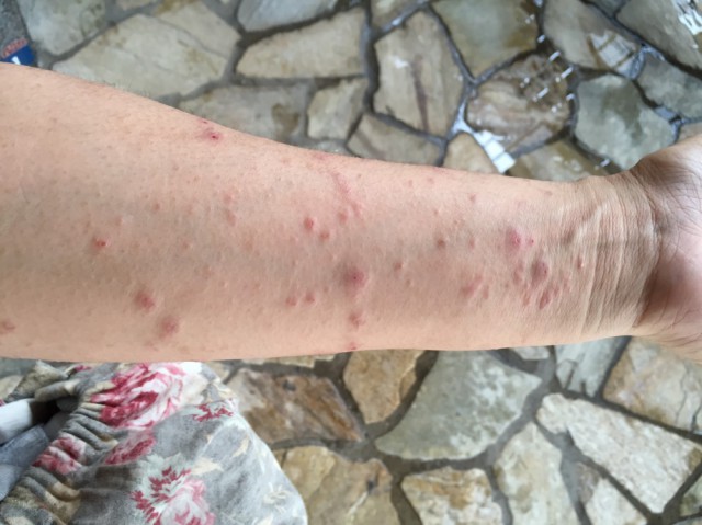 アップルウォッチで腕に湿疹が出来ました - Apple コミュニティ