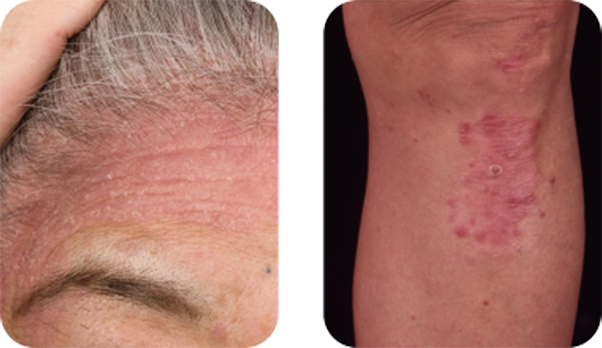 尋常性乾癬豊中市の千里中央スキンクリニック 皮膚科美容皮膚科 医療ハイフ・医療脱毛など