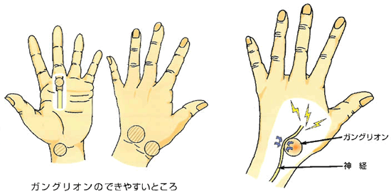 左手親指つき指 左母指MP関節捻挫ひろた鍼灸整骨院