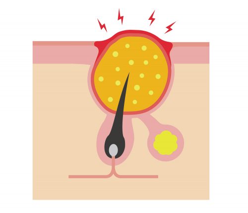 夢占い にきびの夢疲労を象徴？深層心理とは？数、大きさ、など状況別解説 – スピリチュアルコラム・占い師ブログサイト占いクラウド