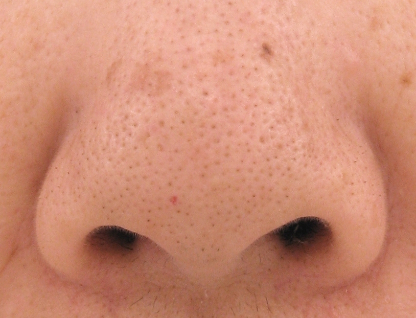 毛穴治療 黒ずみ・開き美容皮膚科はTCBスキンクリニック