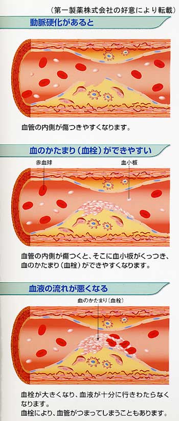 MRI MRA画像あり 脳動脈瘤の種類、頻度、好発部位、画像所見まとめ