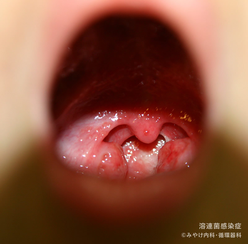 見てわかるのどの病気 耳鼻咽喉科内藤クリニック