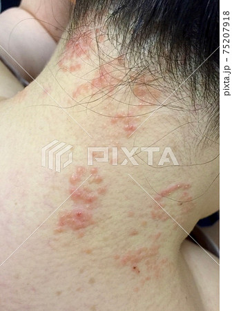 乾癬不「只」是皮膚病，而是比想像中更「炎」重的疾病！ - PanSci 泛科學