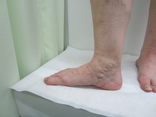 足のむくみ診療爪 足病外来についてむとうクリニック