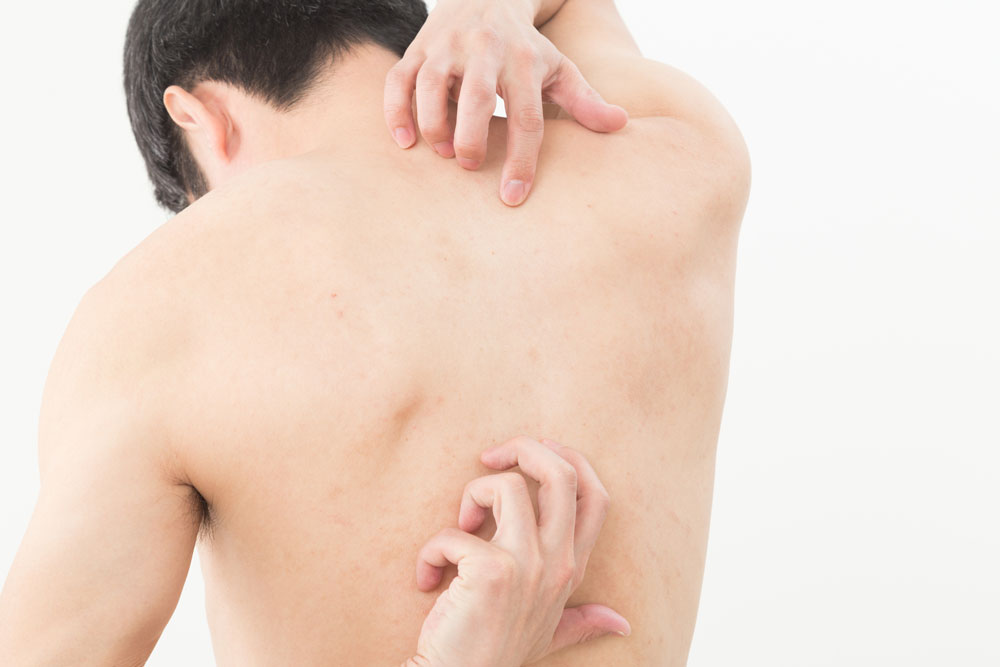 私の背中にアトピー性皮膚炎 - 太陽のストックフォトや画像を多数ご用意 - 太陽, 斑点, 皮膚炎 - iStock