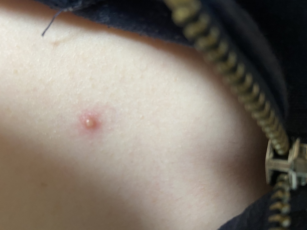 大きいニキビの原因と効果的な治し方粉瘤との見分け方も解説 -天神みきクリニック 福岡市天神・美容皮膚科シミ取り・赤ら顔治療