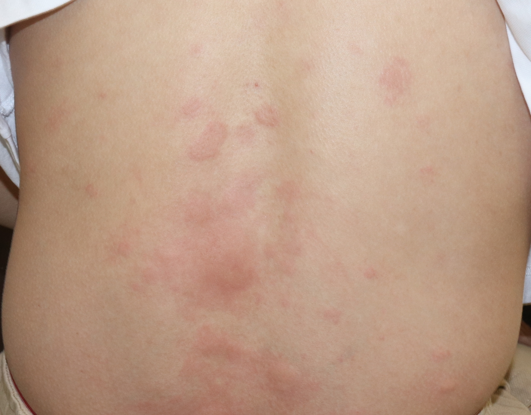 蕁麻疹 じんましん の原因＆対処法薬局・薬店で相談できる皮膚トラブルヒフシルワカル